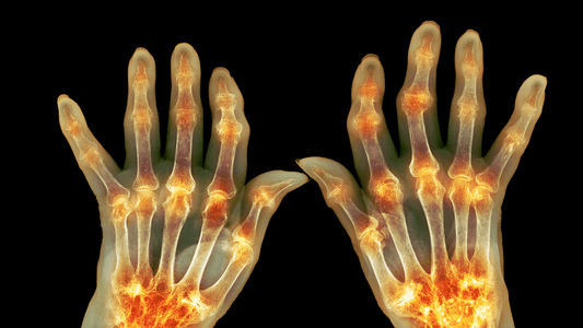 Arthritis – The Inflammatory Disease - Velobiotics 