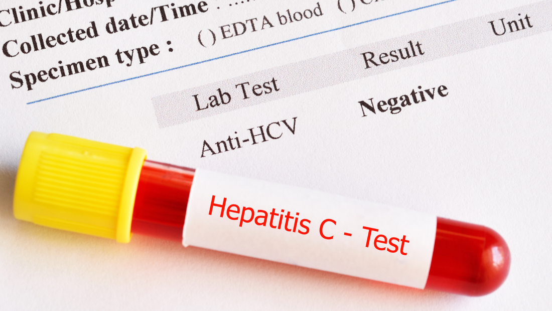 Blood sample tube labeled Hepatitis C test with negative anti-HCV lab result on medical report for Chronic Hepatitis C infection summary